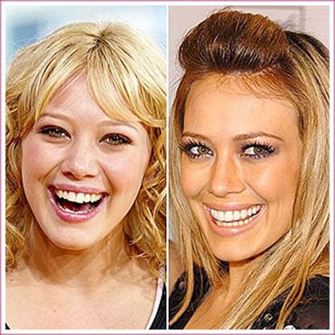 Hilary Duff before and after surgery #BotoxTips | Celebrity plastic surgery, Hilary duff plastic ...