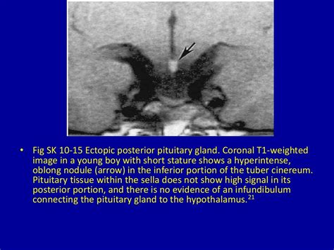 10 hypothalamic lesions on magnetic resonance imaging