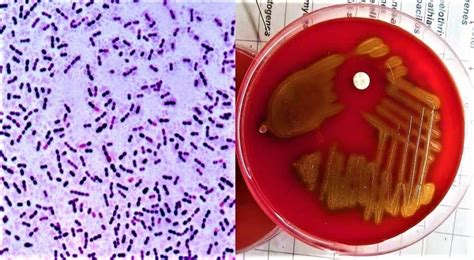 Streptococcus Pneumoniae Blood Culture