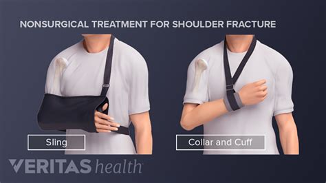 Treating a Proximal Humerus Fracture