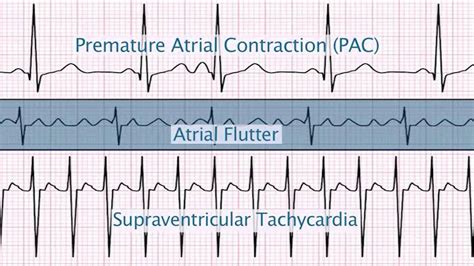 "Supraventricular Arrhythmias" by Christine LaGrasta, MS, RN, CPNP PC/AC, for OPENPediatrics ...