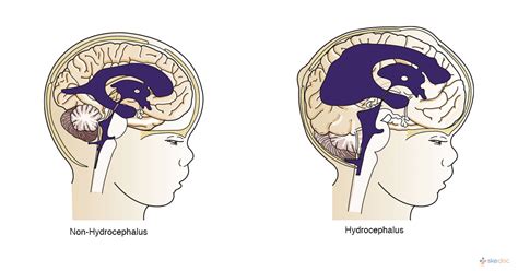 Hydrocephalus | Symptoms, Treatment, Causes, Types, and Diagnosis