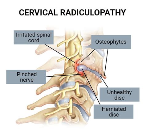 Cervical Radiculopathy Treatment in NJ & NYC