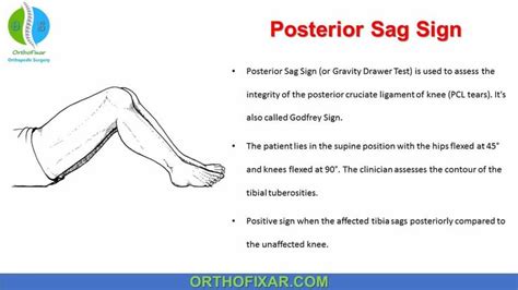 Posterior Sag Sign | Human anatomy and physiology, Cruciate ligament ...