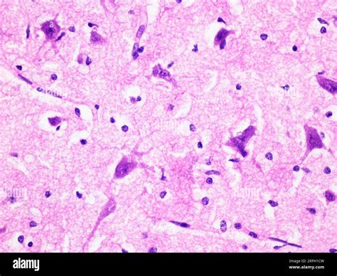 Histology of Human Brain Tissue Viewed at 400x Magnification with Haematoxylin and Eosin ...