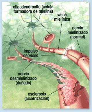 Esclerosis Múltiple - Fisioterapia Neurológica