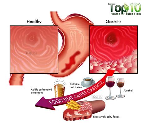 Home Remedies for Gastritis | Top 10 Home Remedies