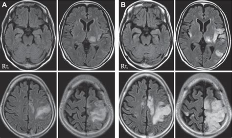 Herpes simplex encephalitis presenting as stroke-like symptoms with atypical MRI findings and ...