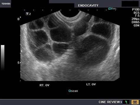 Theca lutein cysts | Ultrasound sonography, Diagnostic medical ...