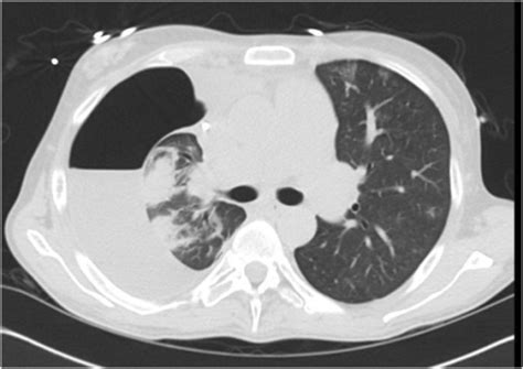 Chest CT post-OLT: Large right-sided hydropneumothorax | Open-i