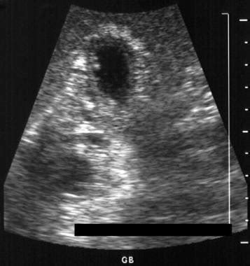 Adenomyomatosis Imaging: Practice Essentials, Radiography, Computed ...