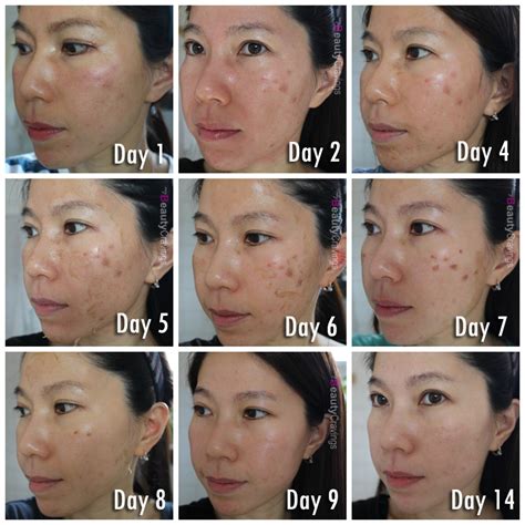 VI Precision Peel | Unexpected pain & long recovery » myBeautyCravings