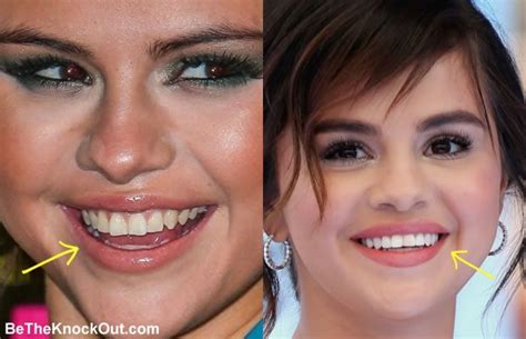 Selena Gomez Plastic Surgery Comparison Photos | Selena gomez teeth, Selena gomez, Plastic surgery