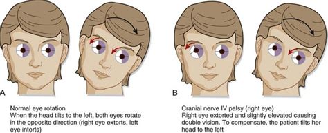 Cranial Nerve Disorders | Clinical Gate