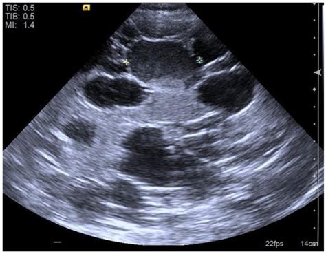 Liver ultrasound of an ADPKD patient with PLD. A cyst 4.2cm at left... | Download Scientific Diagram