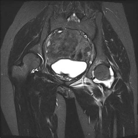 Septic arthritis caused by Brucella melitensis in urban Shenzhen, China: a case report | Journal ...