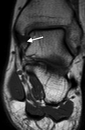 Deltoid Ligament