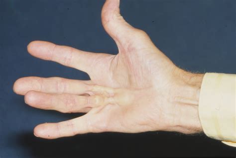 Dupuytren Contracture Pictures - Dupuytren Contracture Institute