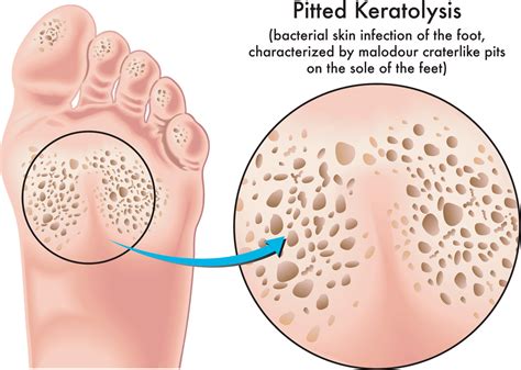 Understanding Pitted Keratolysis: Causes, Symptoms, and Diagnosis - Foot and Ankle Group