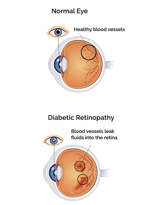 Diabetic Retinopathy | Diabetes Eye Exam in Southside | AEG A1A Family EyeCare