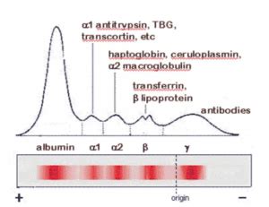 Interpreting serum protein electrophoresis (SPE) patterns – BCIT News