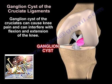 Ganglion Cysts Around The Knee - Everything You Need To Know - Dr. Nabil Ebraheim - YouTube