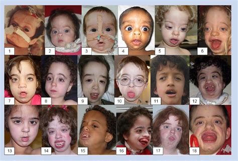 Phenotype and natural history in Marshall-Smith syndrome. | Semantic ...