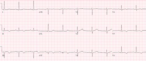 Hyperacute T waves and Occlusion MI | ECG Cases| Emergency Medicine Cases