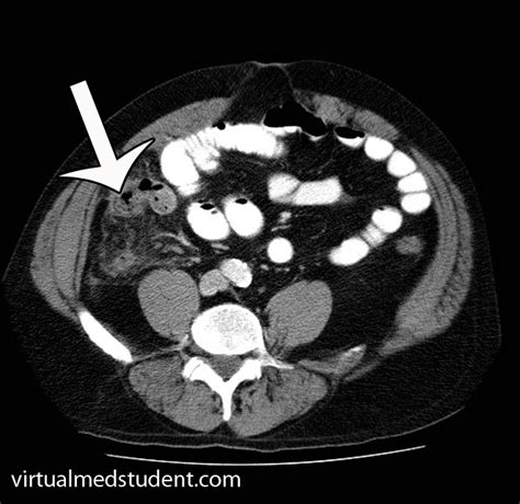 Appendicitis: A Vestigial Remnant to Belly Pain - VirtualMedStudent.com