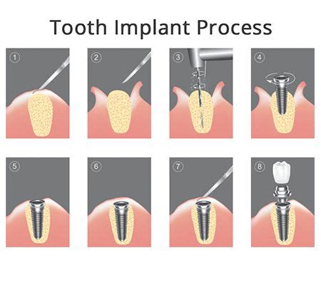 Tooth Implant Process, Timeline | LuxDen Implants Center Brooklyn NY