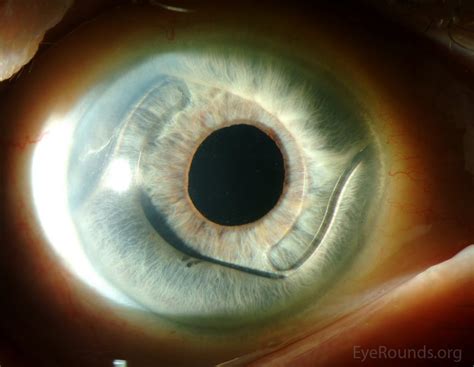 Atlas Entry - Anterior chamber intraocular lens (ACIOL) implant