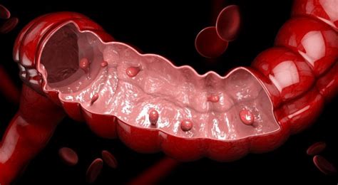 Your guide to making polyp removal decisions | American Gastroenterological Association