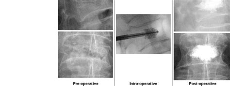 Images of a L1 kyphoplasty using the SKy Bone Expander System | Download Scientific Diagram