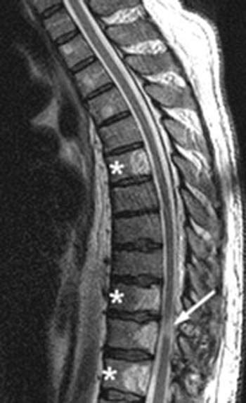 HEMANGIOMA SPINE MRI T1 T2 - Wroc?awski Informator Internetowy - Wroc?aw, Wroclaw, hotele Wroc ...