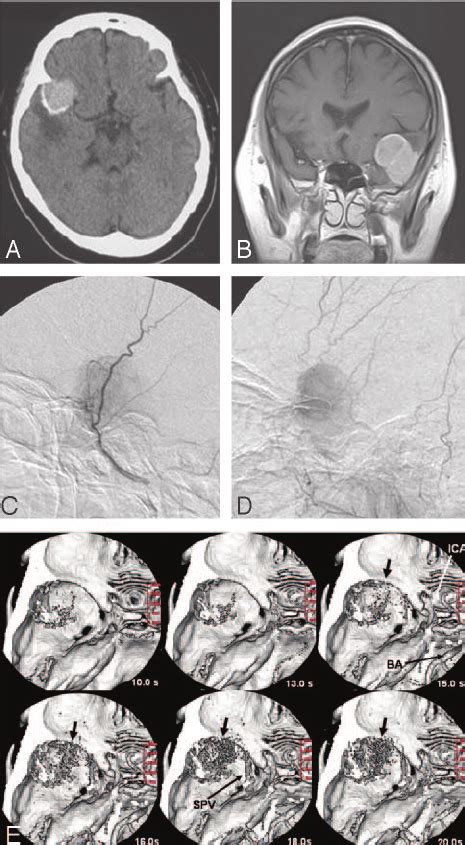 A 52-year-old woman with a sphenoid ridge meningioma (case 3). A ,... | Download Scientific Diagram