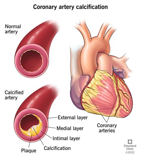 Coronary Artery Calcification: Causes, Symptoms & Treatment