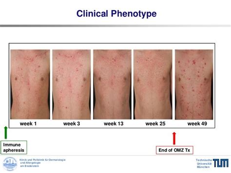 Targeting grossly elevated IgE: a novel therapeutic option in severe