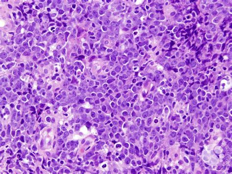 Diffuse large B-cell lymphoma, Leg type 1