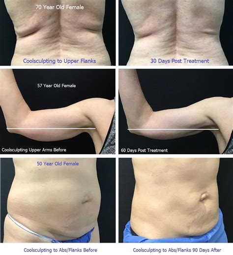 Atlanta Coolsculpting Before & After Photos