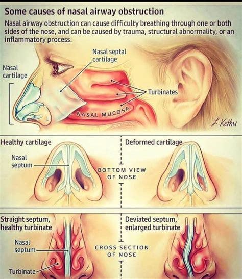 Causes of nasal obstruction - MEDizzy