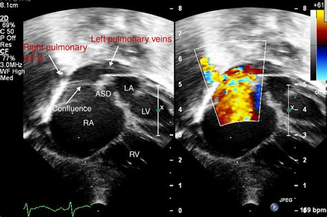 Subcostal transthoracic echocardiographic views showing drainage of the... | Download Scientific ...