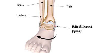 Inside Ankle Pain (Medial) - Symptoms, Causes, Treatment & Rehab