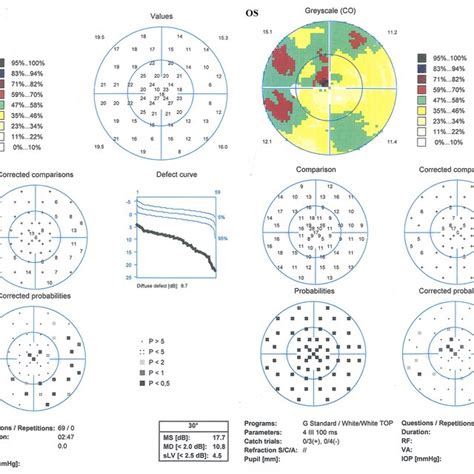 Goldmann visual field testing characteristics of the proband (II 1).... | Download Scientific ...