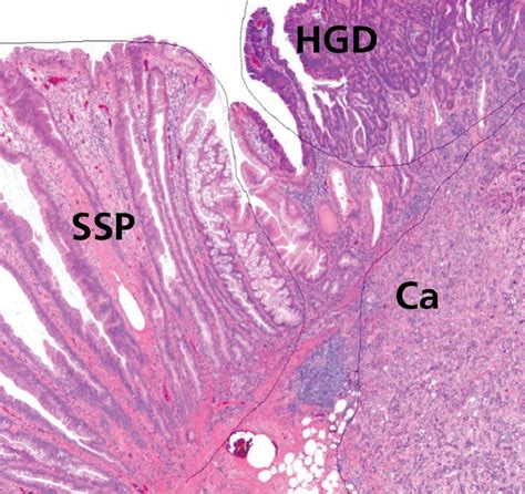 Showing 4 Serrated Polyp Subtypes A Microvesicular