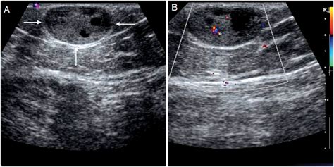 Eccrine Spiradenoma of the Thigh: Sonographic Findings and Review of ...