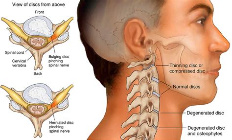 Cervical radiculopathy causes, symptoms, diagnosis & treatment