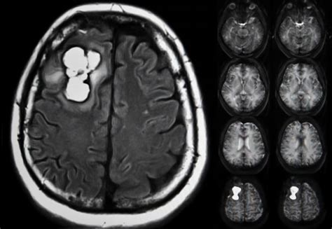 Understanding Brain Tumors, Diagnosis and Treatment