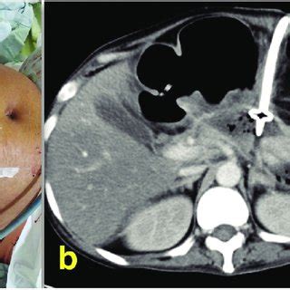 Percutaneous catheter drainage: a) clinical image depicting... | Download Scientific Diagram