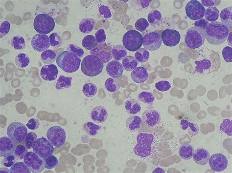 Chronic Myelogenous Leukemia