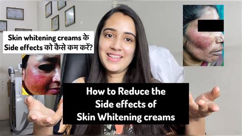 Skin whitening creams side effects | How to reduce side effects | Harmful steroid/fairness ...